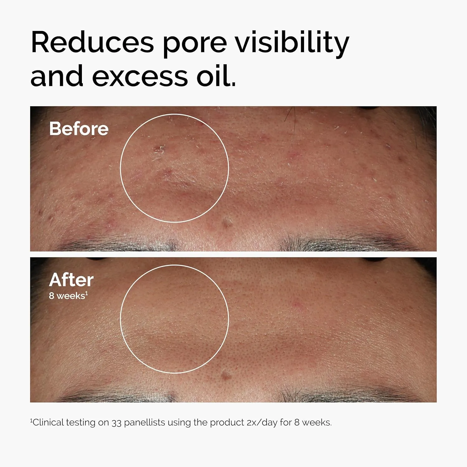 The Ordinary Niacinamide 10%   Zinc 1%, Smoothing Serum for Blemish-Prone Skin